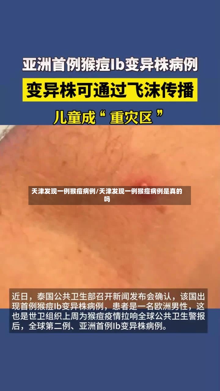 天津发现一例猴痘病例/天津发现一例猴痘病例是真的吗
